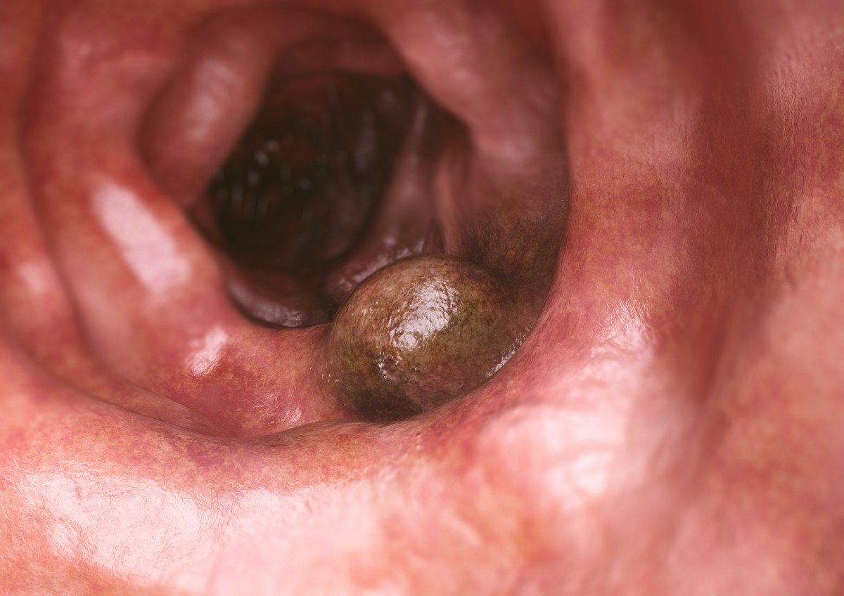 colon-cancer