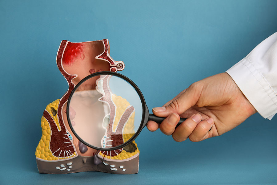 Cross-section model showing haemorrhoids examined with magnifying glass — illustration for piles surgery in Singapore.